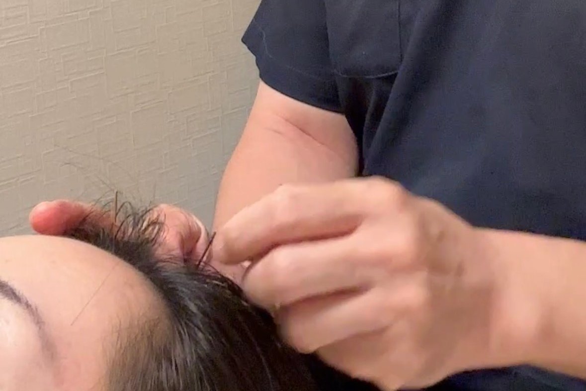 院長が女性の生え際に鍼を置いている手元