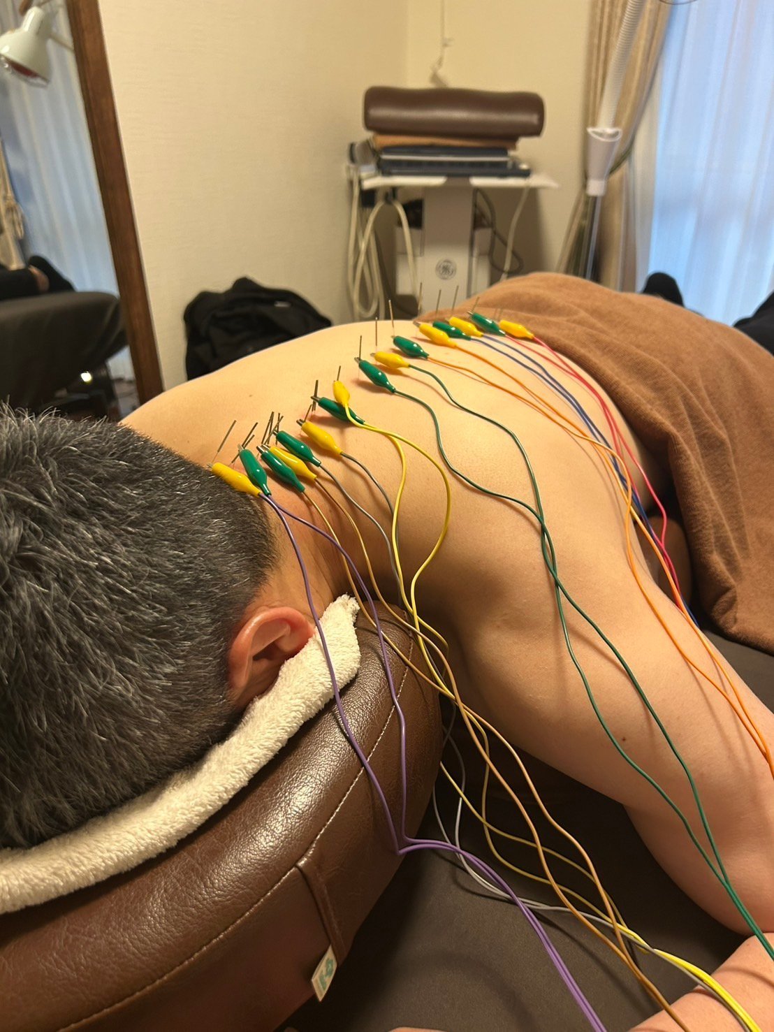 背中に鍼を置き、鍼通電（パルス）をしている様子